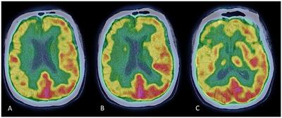 Case report: Atypical Parkinsonism following SARS-CoV-2 infection